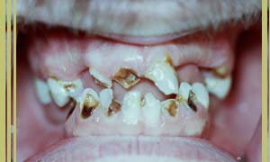 photo of meth mouth